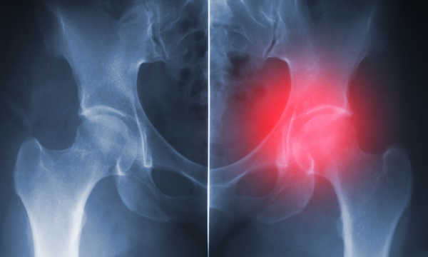 Żywotność endoprotezy stawu biodrowego zależy od rodzaju zastosowanych materiałów, techniki operacyjnej oraz aktywności pacjenta