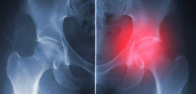 Jaka jest żywotność endoprotezy stawu biodrowego?