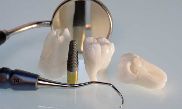 Co to jest implant zębowy?