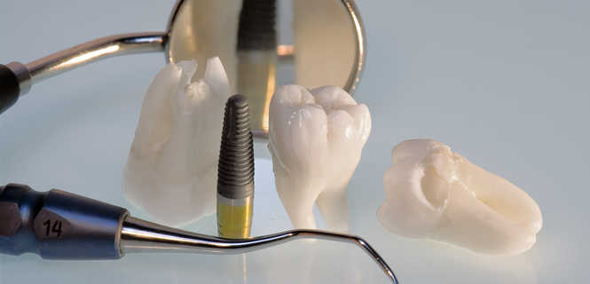 Co to jest implant zębowy?