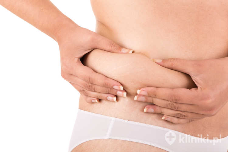 Pacjentka przed zabiegiem kriolipolizy Coolsculpting