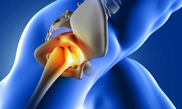 Endoprotezy stawu biodrowego różnią się przede wszystkim sposobem mocowania do kości, wyróżnia się więc endoprotezy cementowe, bezcementowe oraz hybrydowe