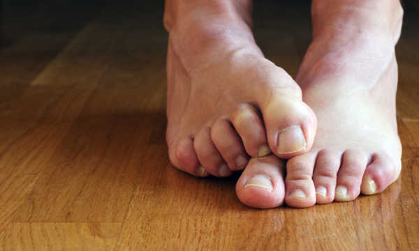 Leczenie przykurczu palców stopy w chorobie Dupuytrena polega na zmniejszeniu napięcia patologicznych pasm tkanki łącznej