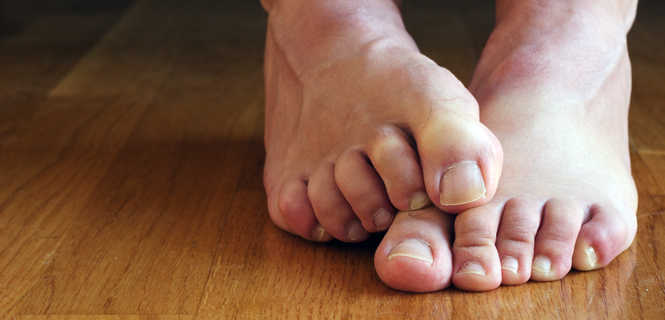 Leczenie przykurczu palców stopy w chorobie Dupuytrena