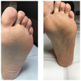 Podologia, leczenie chorób stopy przed i po zabiegu