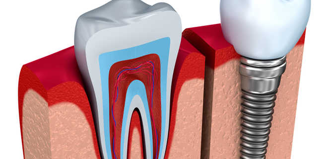 Rodzaje implantów stomatologicznych