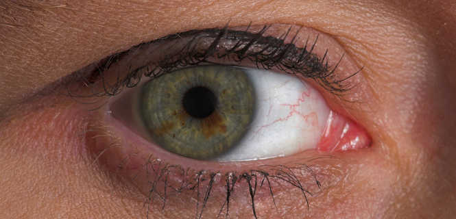 Topografia rogówki - badanie przy kwalifikacji pacjenta do laserowej korekcji wady wzroku