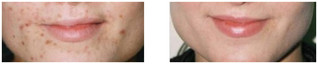 Blizny potrądzikowe na brodzie - usuwanie laserem przed i po zabiegu