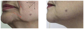 Karboksyterapia - bruzdy nosowo-wargowe przed i po zabiegu