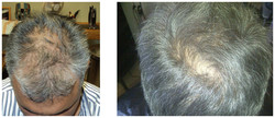 Karboksyterapia - pobudzenie cebulek włosowych przed i po zabiegu