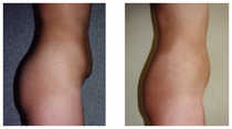 Liposukcja klasyczna SAL przed i po zabiegu