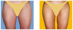 Liposukcja klasyczna SAL przed i po zabiegu
