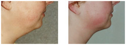 Liposukcja podbródka przed i po zabiegu