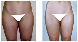 Liposukcja ud zewnętrznych i wewnętrznych przed i po zabiegu