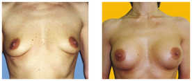 Operacje plastyczne piersi przed i po zabiegu