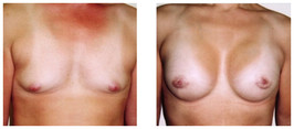 Operacyjna korekcja płci z męskiej na żeńską przed i po zabiegu