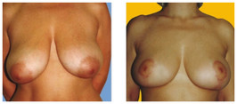 Podniesienie piersi przed i po zabiegu