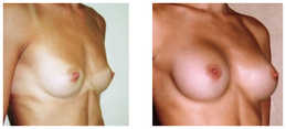 Powiększanie piersi przed i po zabiegu