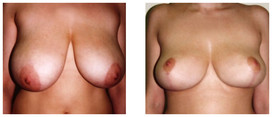 Zmniejszenie piersi przed i po zabiegu
