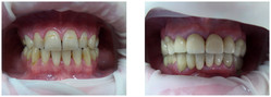 Licówka pełnoceramiczna przed i po zabiegu