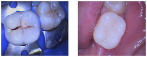 Stomatologia zachowawcza przed i po zabiegu
