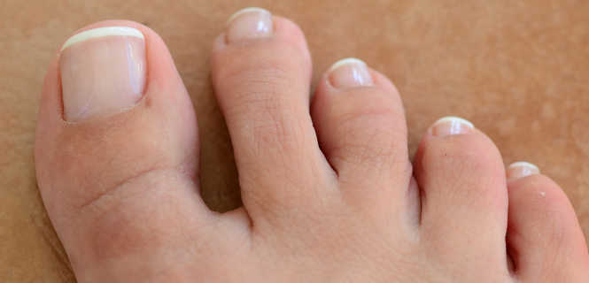 Wrastające paznokcie – leczenie za pomocą klamer drutowych metodą ortonyksji