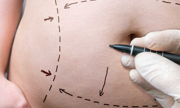 Abdominoplastyka brzucha