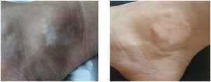 Bielactwo - pigmentacja medyczna przed i po zabiegu