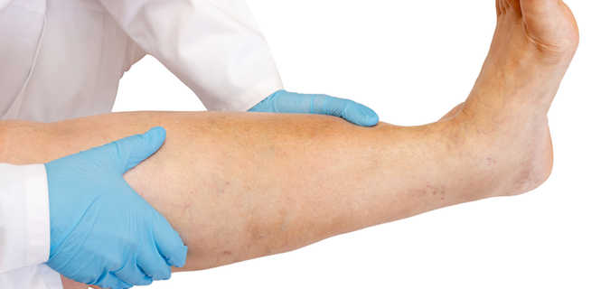 Laser Vena Cure 1470 w leczeniu żylaków nóg