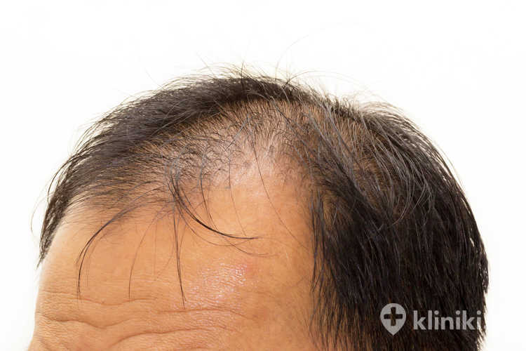 Metody przeszczepu włosów