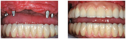 Proteza zębowa stabilizowana na 6 implantach przed i po zabiegu