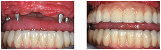 Protezy zębowe przed i po zabiegu