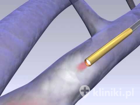 Zamykanie żylaków kończyn dolnych laserem Vena Cure