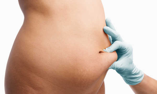 Liposukcja brzucha - popularny zabieg chirurgii plastycznej