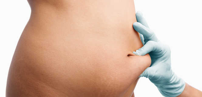 Liposukcja brzucha - popularny zabieg chirurgii plastycznej