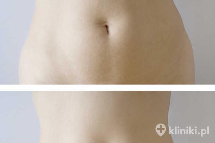 Liposukcja brzucha Smart Lipo - zdjęcia przed i po zabiegu