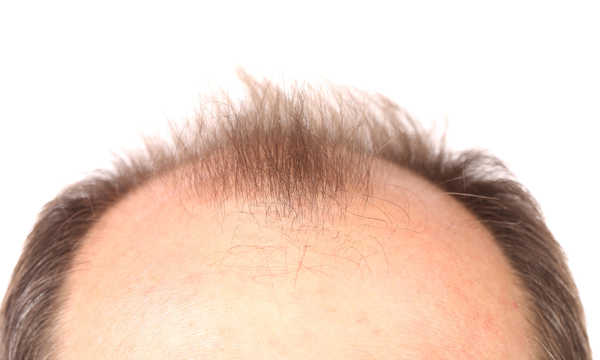 Mikropigmentacja skóry głowy u mężczyzn