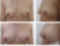 Powiększanie piersi własną tkanką tłuszczową przed i po zabiegu