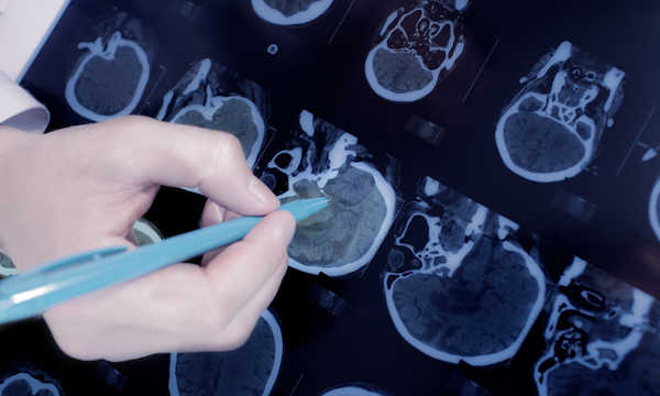 Tomografia komputerowa zatok dokładnie obrazuje zatoki i jamę nosową
