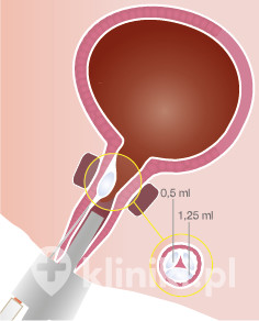 Trzy implanty materiału Urolastic umieszczone wokół cewki moczowej