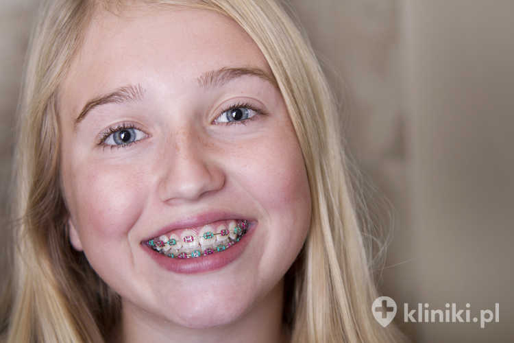 aparat ortodontyczny