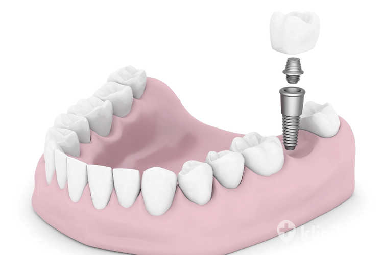 Implanty OCO Biomedical