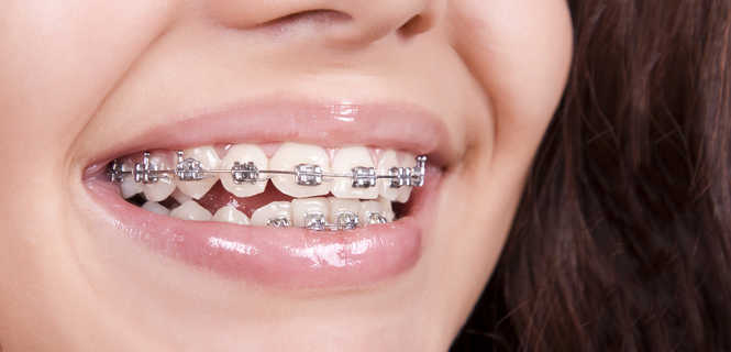 Leczenie wad zgryzu aparatem ortodontycznym stałym - jak to działa?