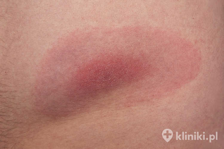 Borelioza to wieloukładowa choroba zakaźna przenoszona przez kleszcze, której najbardziej charakterystycznym objawem wczesnym jest rumień wędrujący