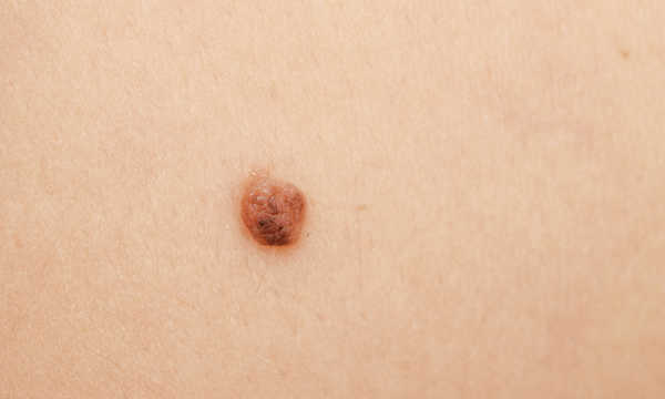 Chirurgia mikrograficzna Mohsa