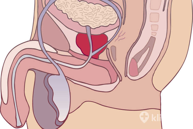 Chirurgiczne leczenie raka prostaty