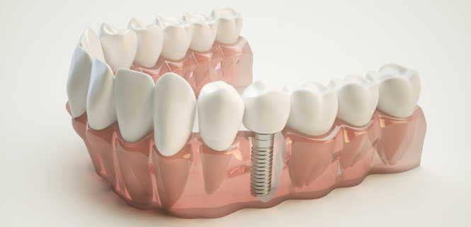 Implanty zębowe Neobiotech