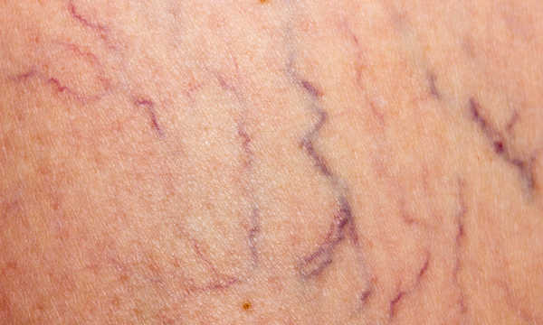 Leczenie żylaków nóg