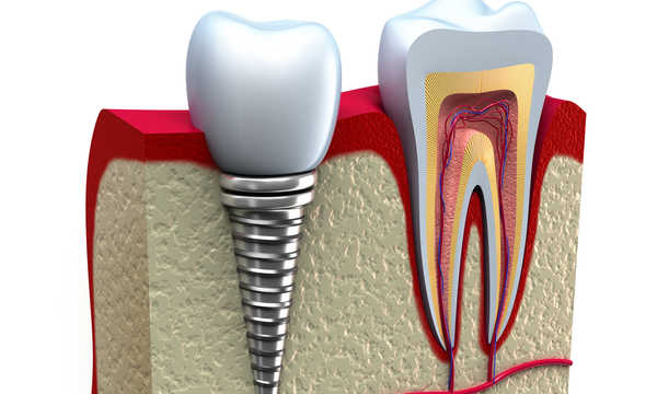Osteointegracja wszczepów zębowych - co to takiego?