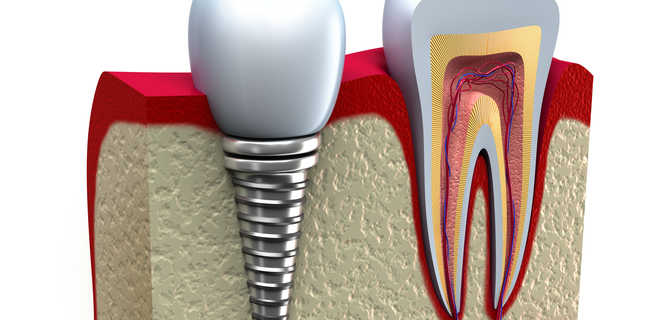 Osteointegracja wszczepów zębowych - co to takiego?